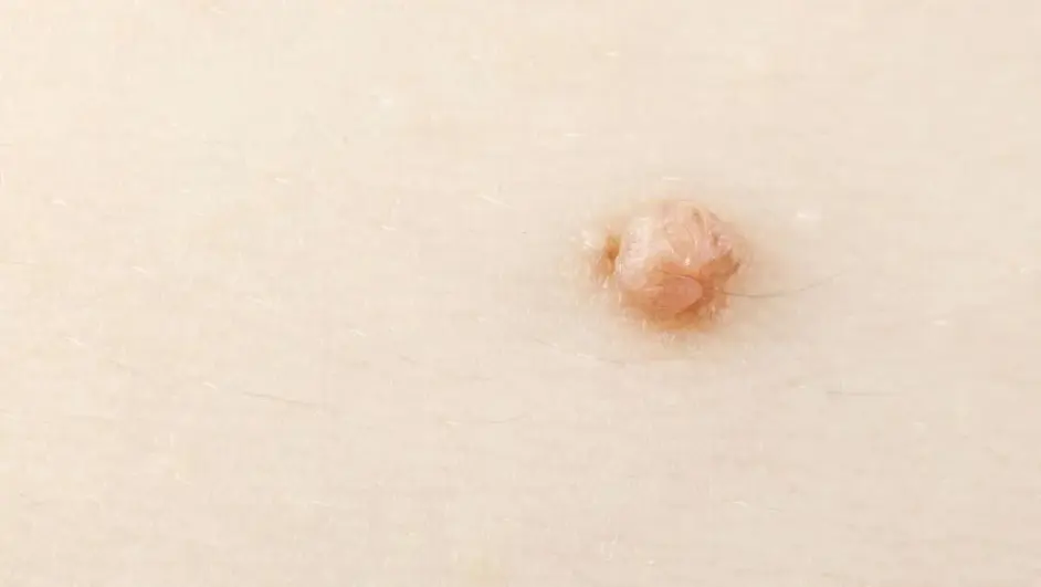 不过,除了痔疮,在肛门处出现的小肉疙瘩还可能发生在肛门处的皮疹.