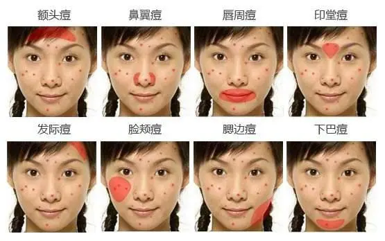 脸上长痘未必是件坏事情 不同位置的痘痘代表你的身体状况 哔哩哔哩