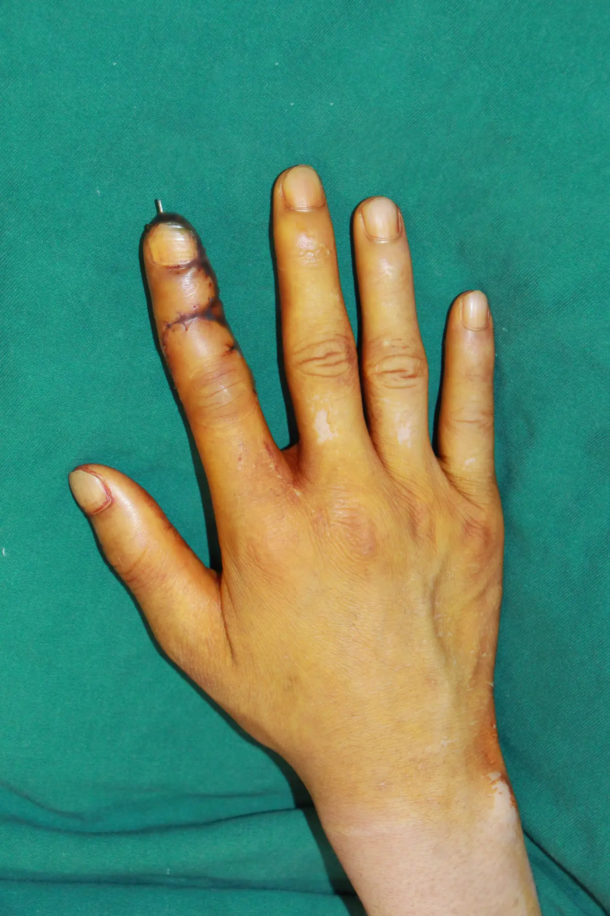 什么是3d全形手指再造 - 哔哩哔哩