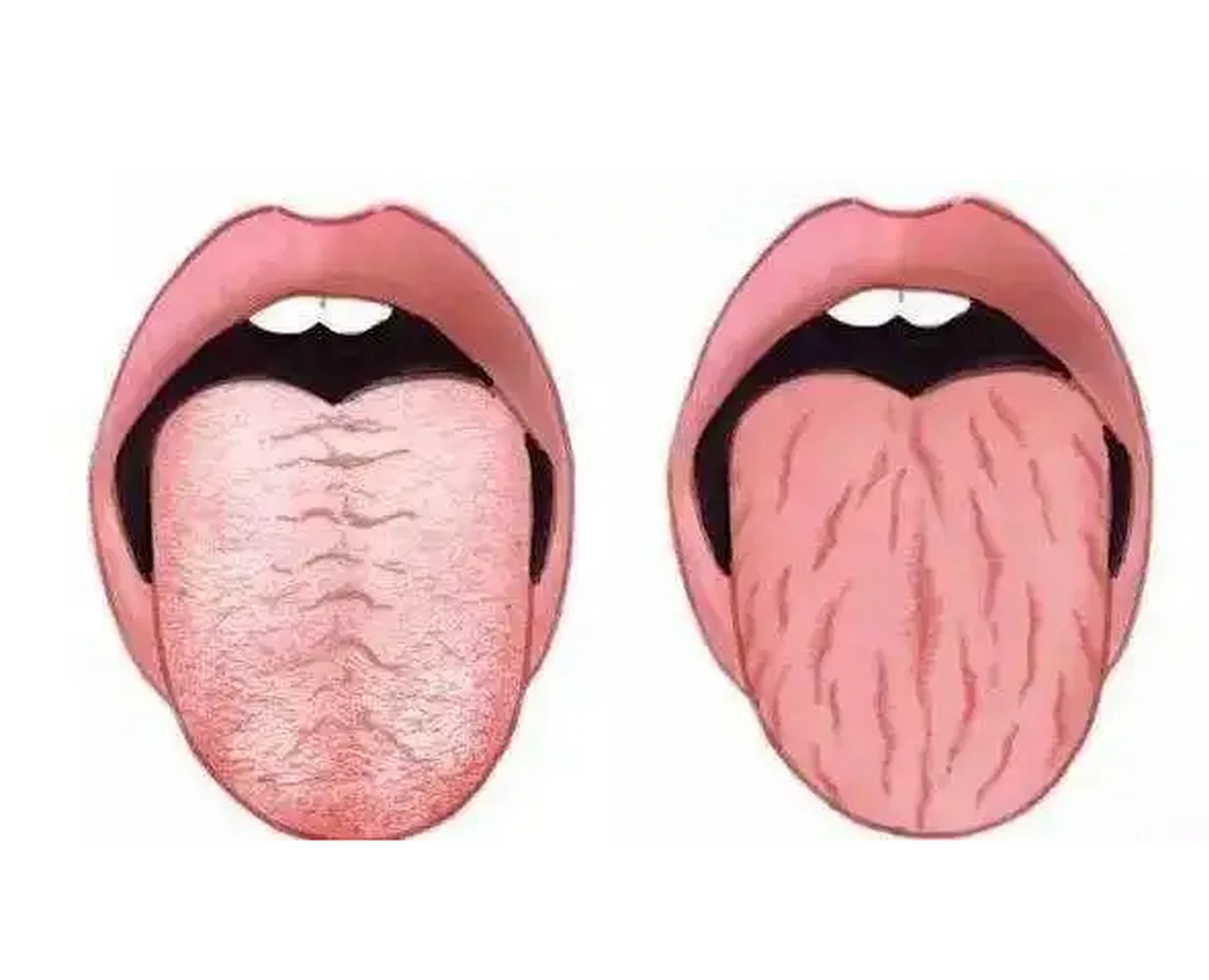 裂纹舌有2种情况，教你看竖纹、横纹分别代表什么问题？-度小视
