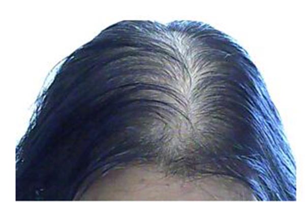 头顶头发少怎么治疗关于 女性生发的四个建议