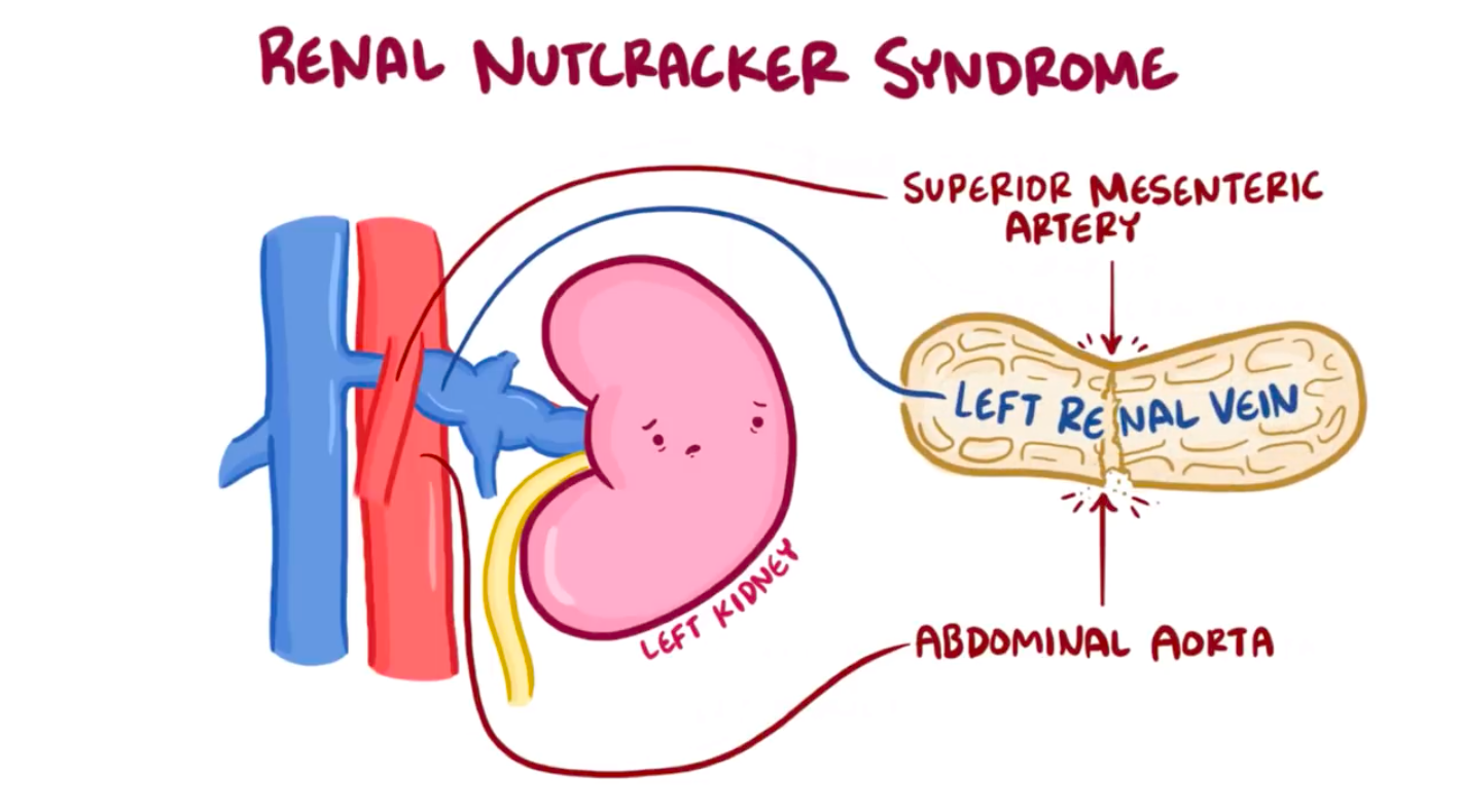 Nutcracker syndrome что это