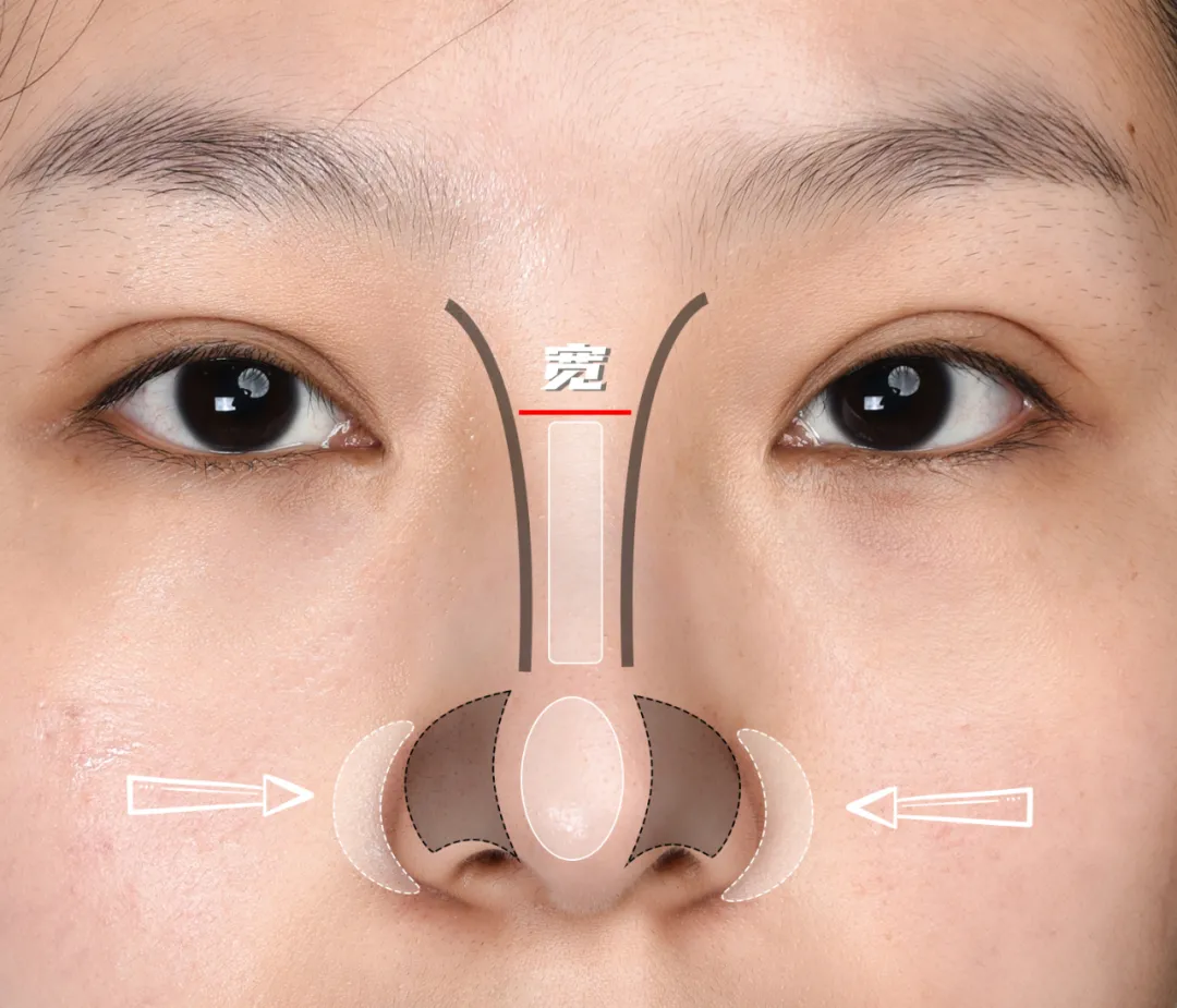 选择适合蒜头鼻、鼻翼缩小的适当手术方法 : [鼻部整形（功能鼻+人中鼻+鼻梁+鼻尖）]前后事例 - 知乎