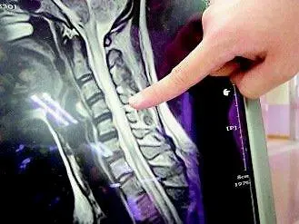 脊髓炎的主要症状问题 固本养髓汤 哔哩哔哩