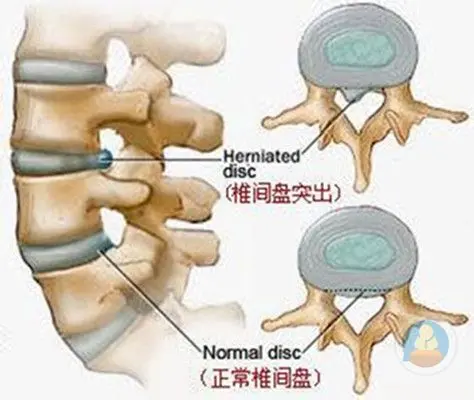 腰椎间盘突出是什么原因引起的 邱氏悬壶 哔哩哔哩