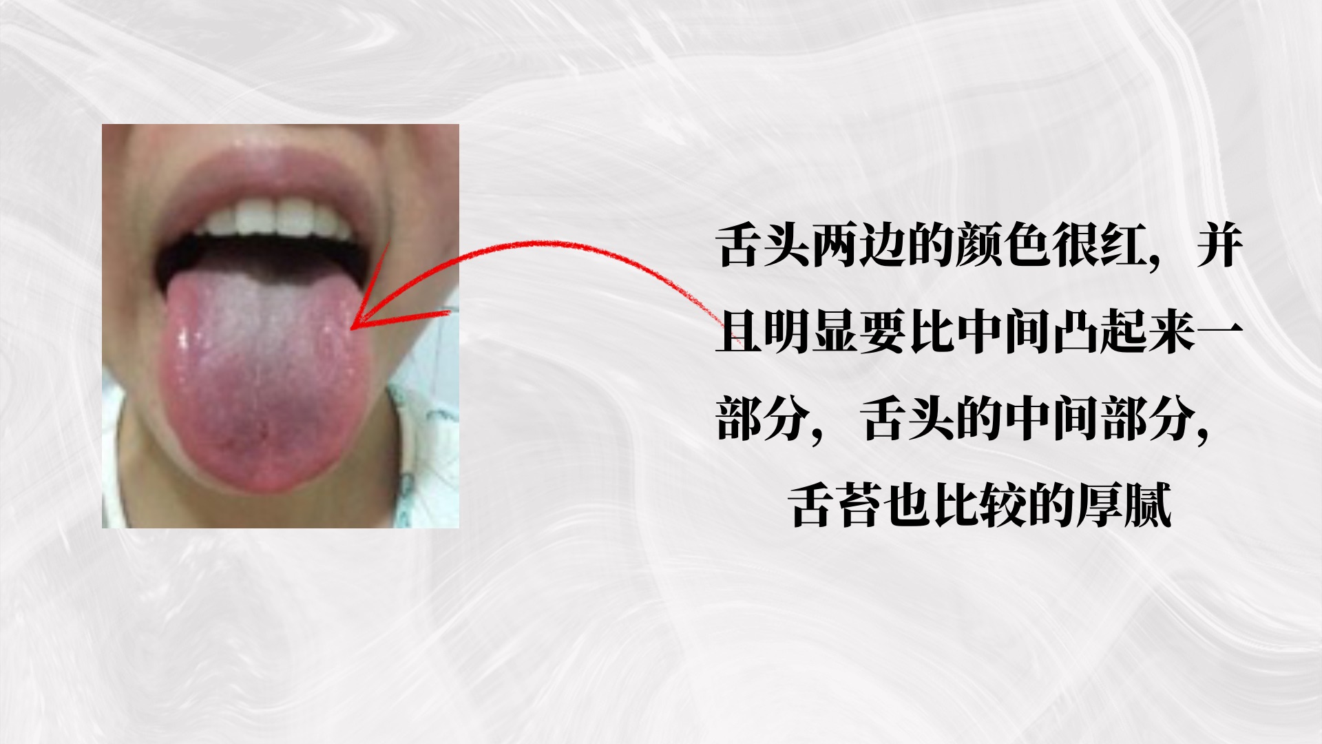 舌の口内炎：歯の接触が原因のケース｜TI歯科医院
