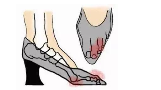 广济医院拇外翻医生解析高跟鞋与拇外翻关系