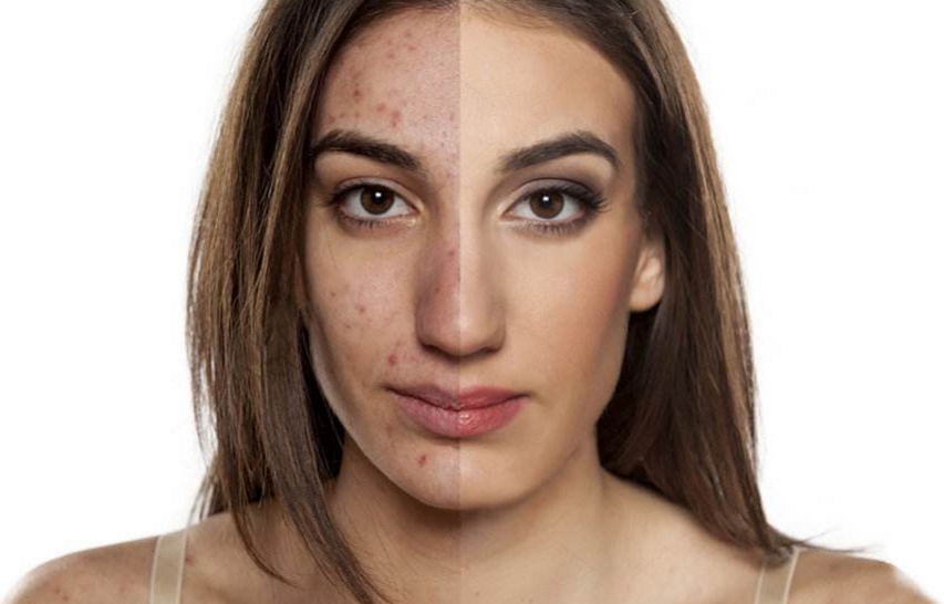 【痘印】一脸的痘印,拉低你的颜值?不要怕教你几个方法去除痘印