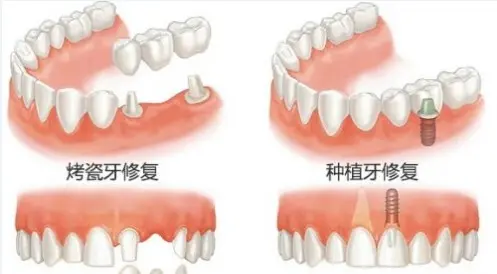 种植牙的过程步骤（三分钟带你明白种植牙全过程）