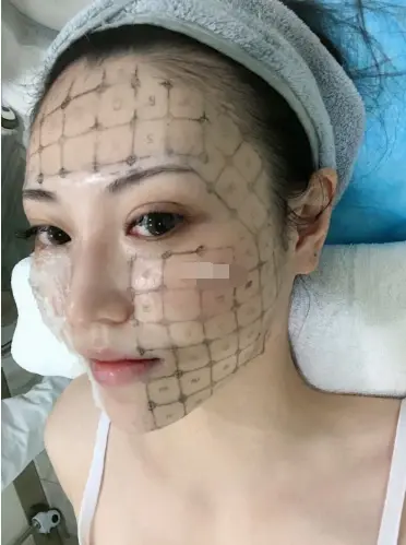 第四代热玛吉详细介绍,热玛吉真假如何辨别