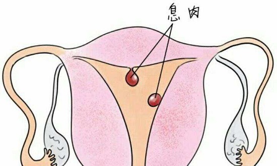 子宫内膜息肉有这一点很可怕,可惜很多人都忽略了!