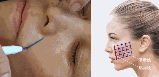 脸上蛋白埋线多久见效,线雕可以做多少次,你敢相信吗?