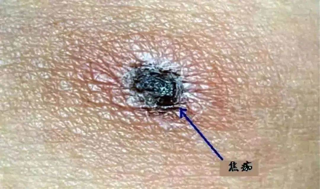 温州8岁女孩发烧休克,原来是被这种雨季最为活跃的虫子咬了