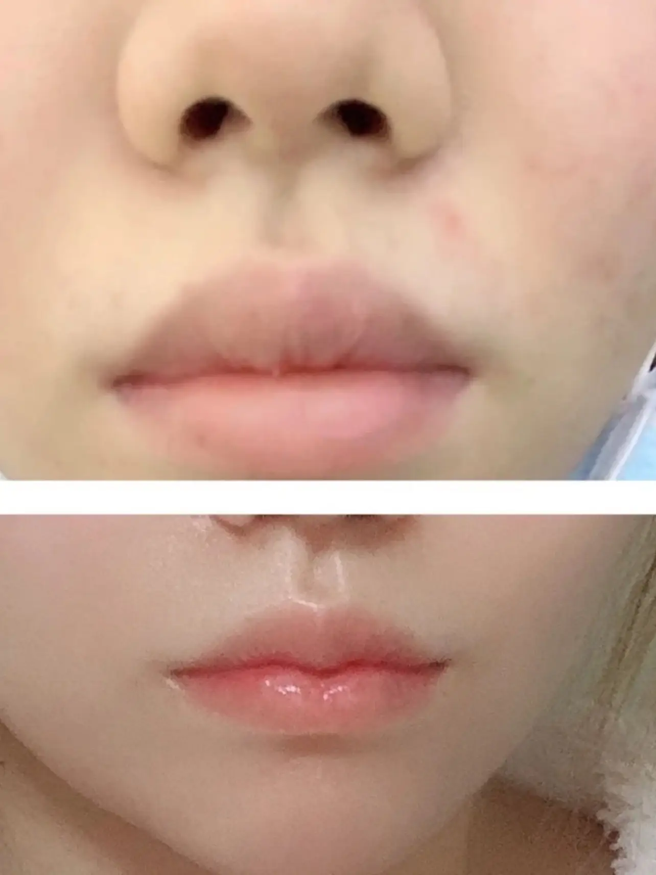 嘴唇填充剂 – Aesthetic clinic in Dubai | Semi permanent makeup | Dermatology clinic