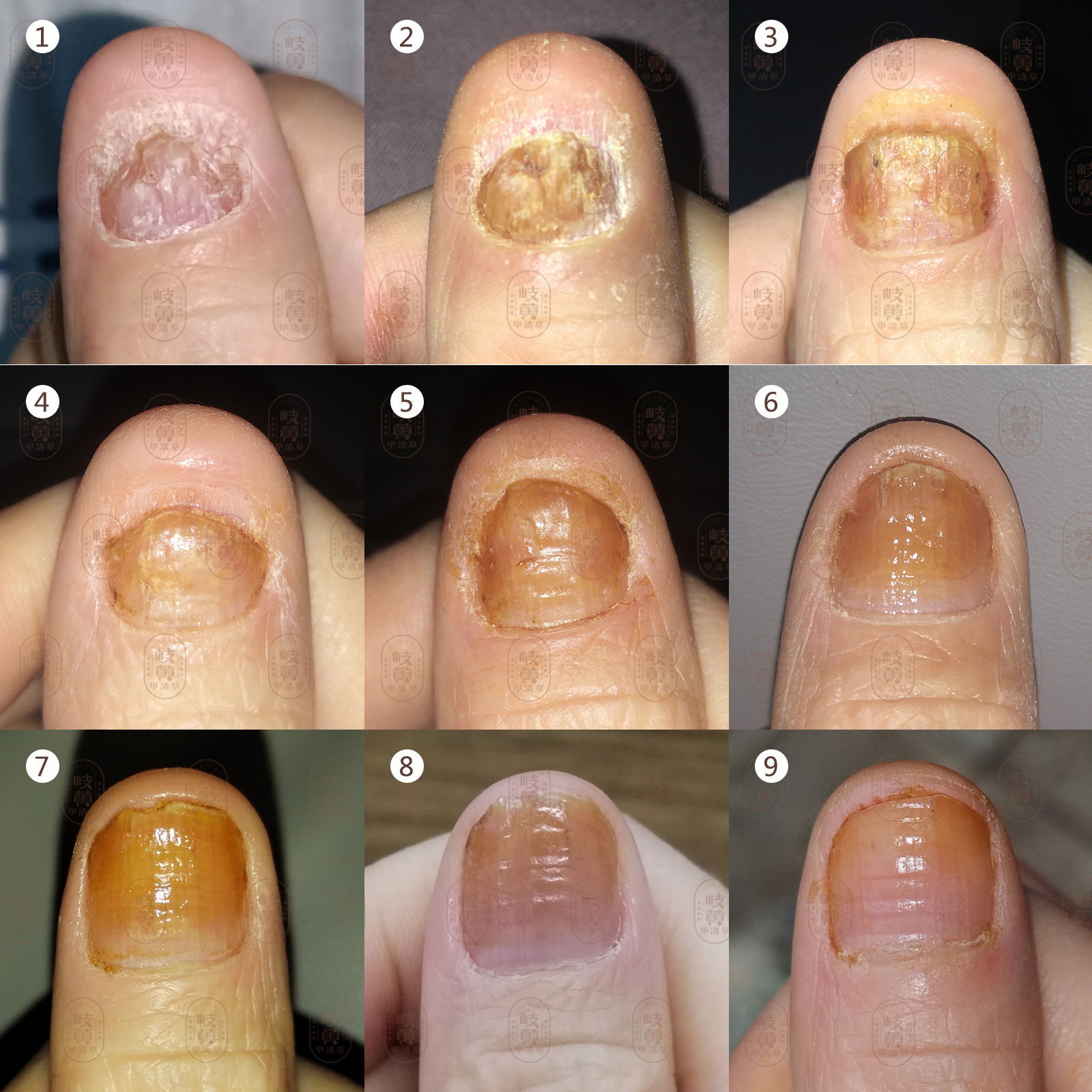 三大灰指甲的症状有哪些-长春华山皮肤病医院