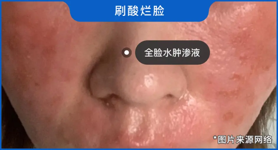 靠 刷酸 就能让皮肤变白变嫩 心动前你一定要看看这篇文章 哔哩哔哩