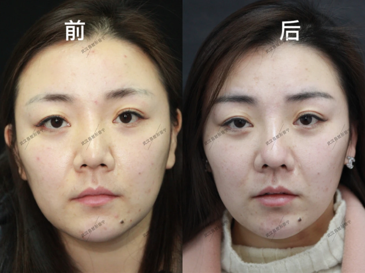 北京美度医美王忠权：膨体隆鼻手术的优缺点是什么 - 哔哩哔哩