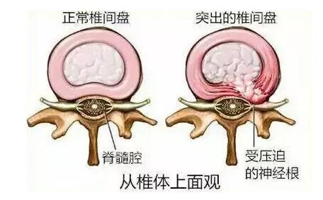 腰椎間盤突出曲度變直反弓該怎麼辦邱氏懸壺