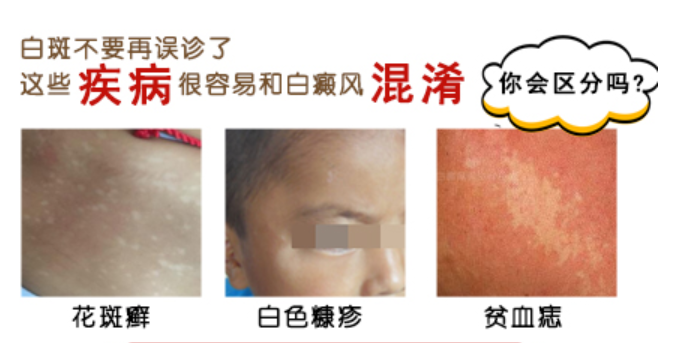 生动的长白斑是缺少什么营养素的视图