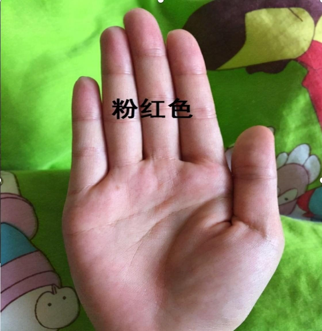 肝掌是怎么形成的？提醒：这几个异常症状，或是肝硬化的早期信号__凤凰网