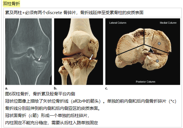 脛骨平臺骨折三柱分類系統:骨科醫生想要知道什麼