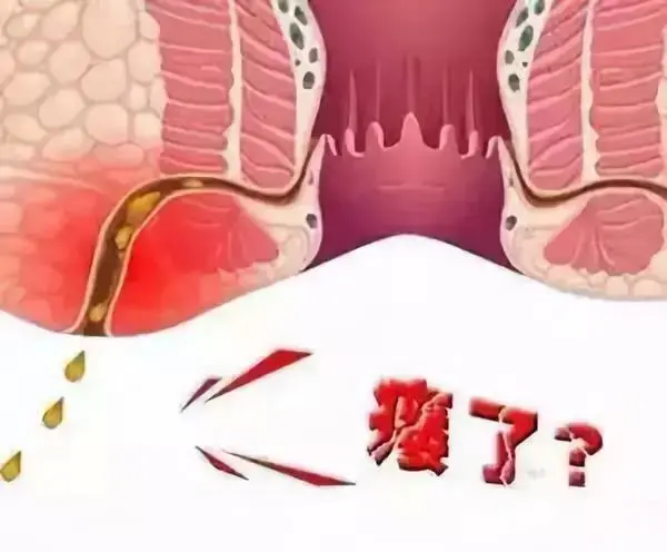 肛瘘的症状是什么? 1、流脓：脓液色黄，伴粪臭味。 2、疼痛：排便、发炎症等都会有明显的疼痛