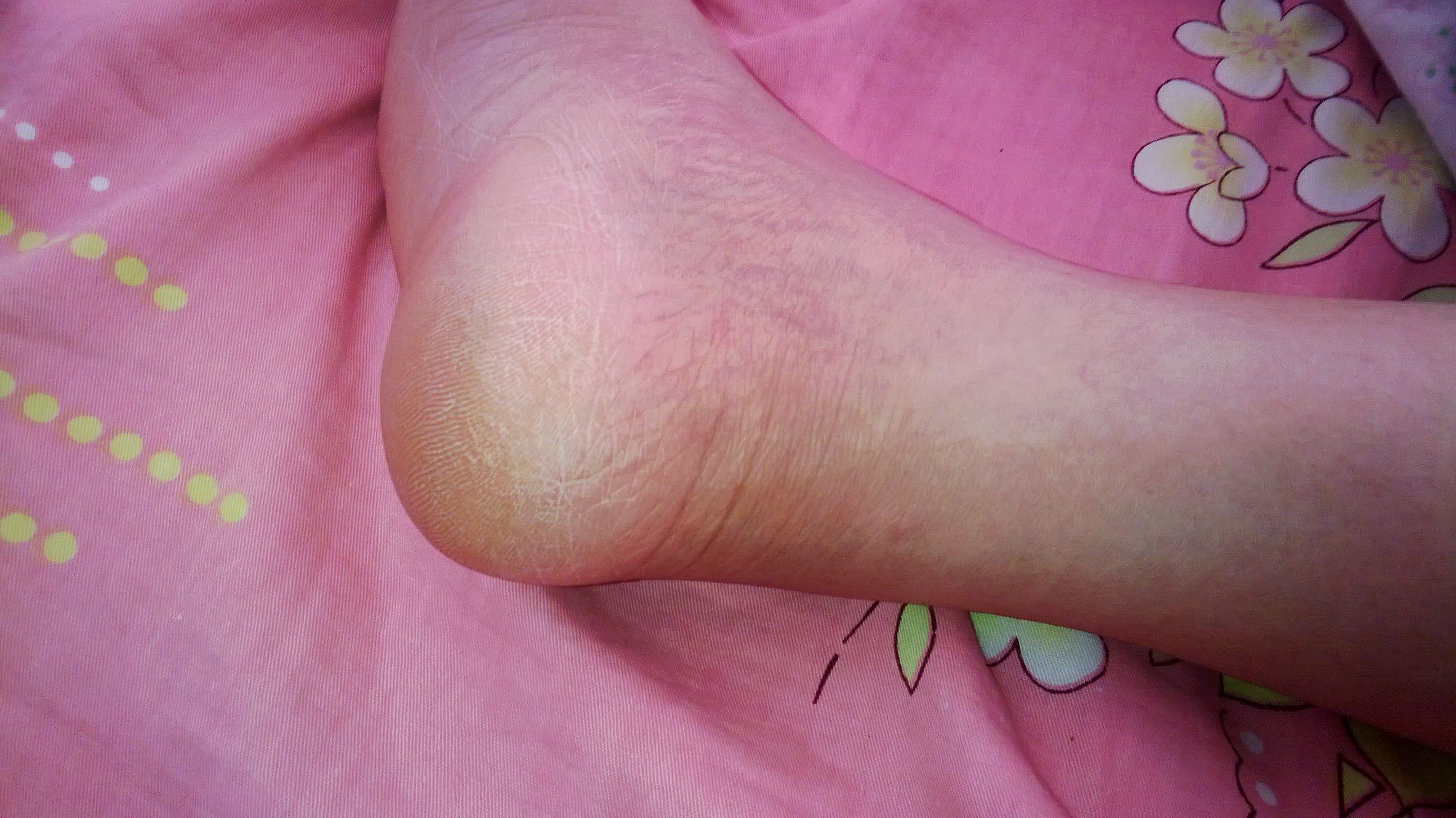 脚底脱皮是怎么回事（秋季手脚经常蜕皮，可能是因为这些原因） | 说明书网