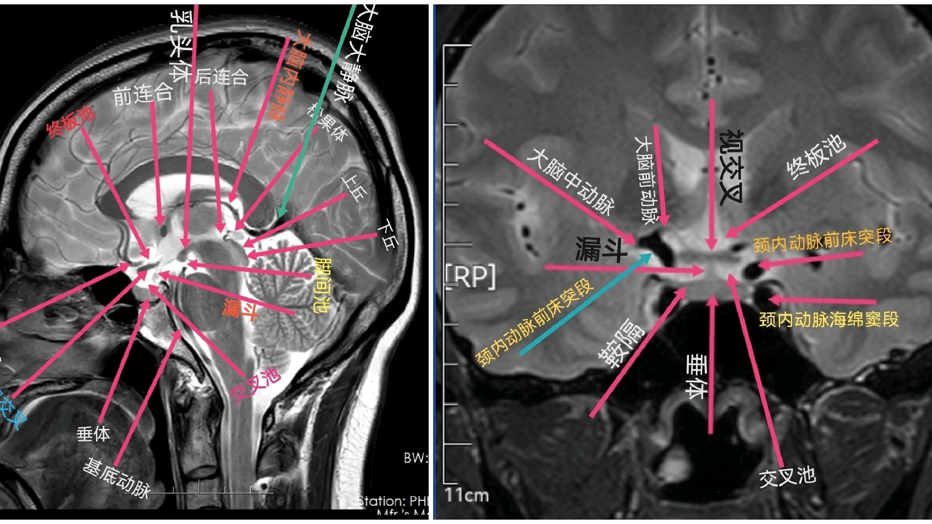 鞍区MRI影像解剖 - 哔哩哔哩
