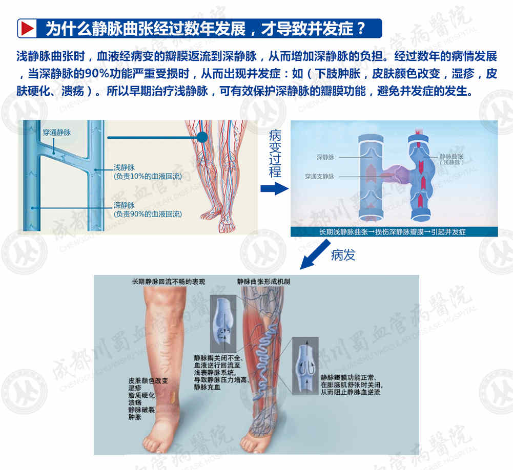 静脉曲张医院甘孜专家治疗好不好 - 哔哩哔哩