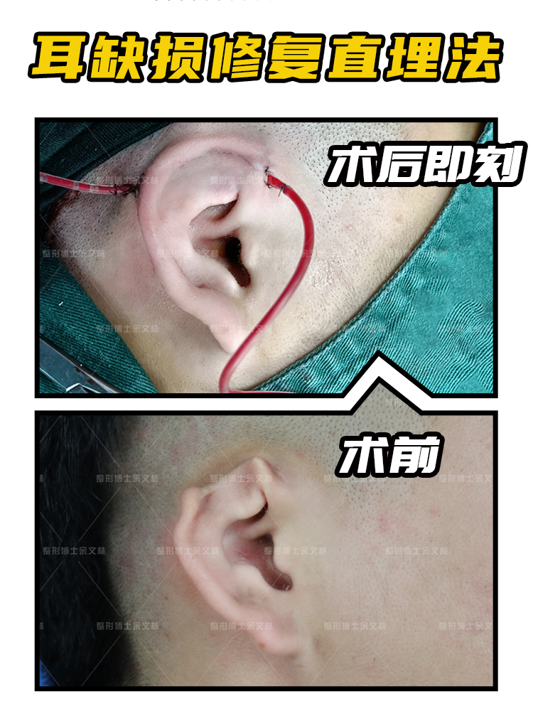 耳专科医院,隐耳矫正术大概多少钱?