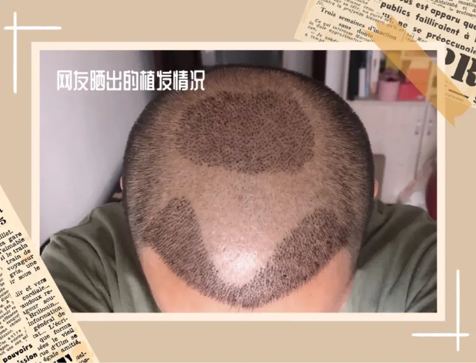 头皮纹发和纹身的迥异 3d纹发和植发的关系 哔哩哔哩