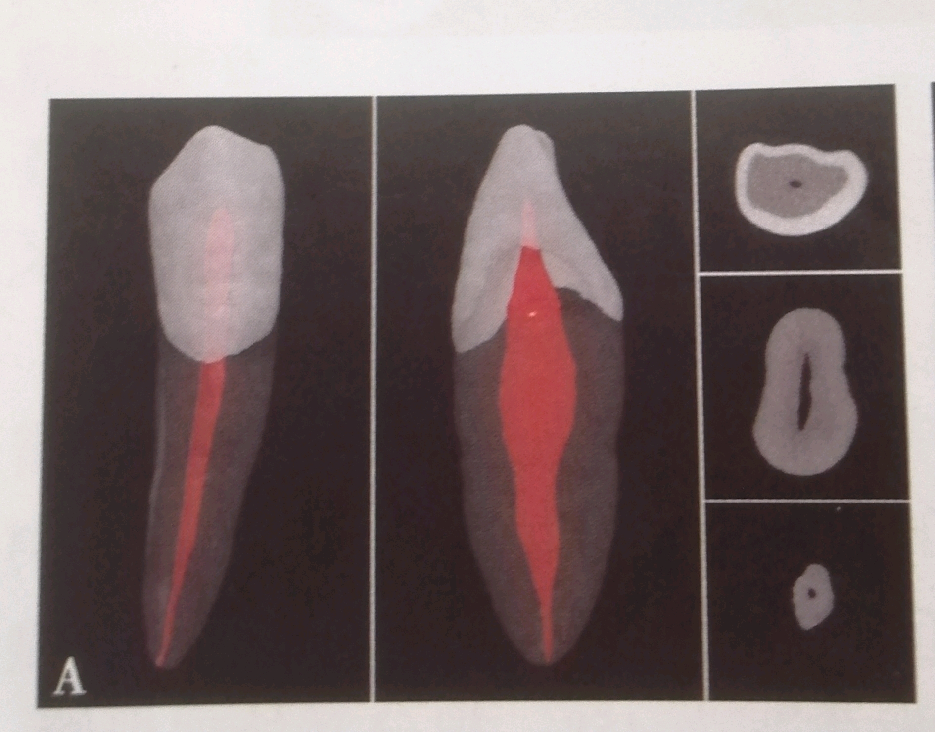 牙髓腔解剖：前牙、磨牙、乳牙髓腔 - 口腔医学 - 天山医学院