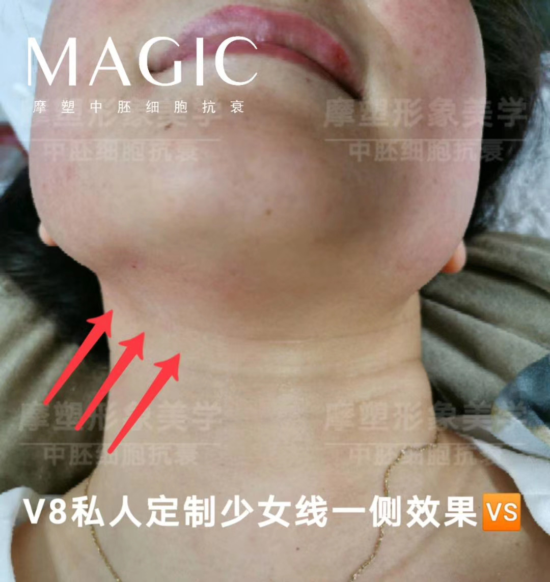 magic摩塑中胚细胞抗衰61v8私人订制少女线塑造