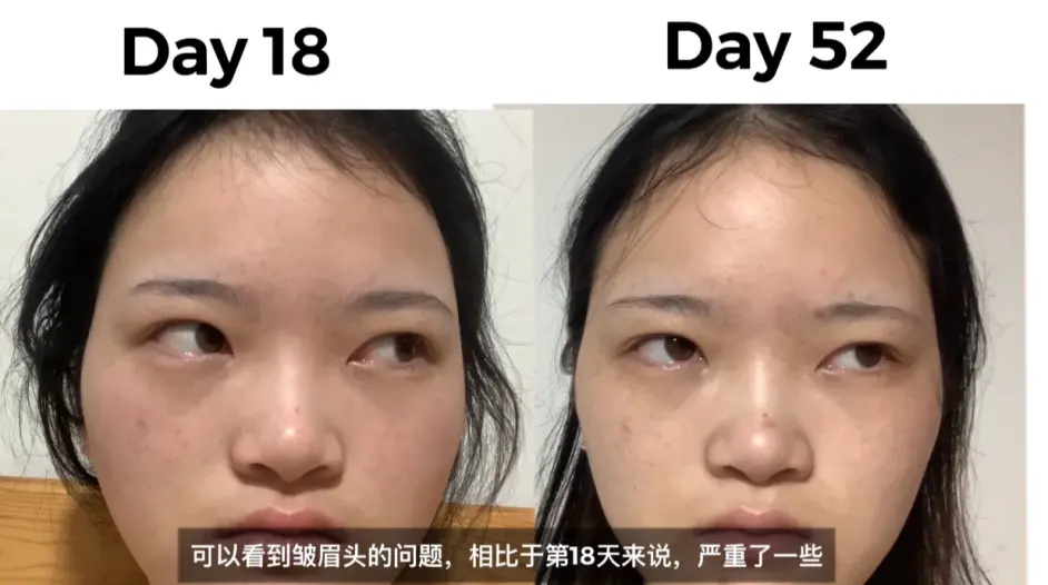 注射肉毒素改善皱眉头 苦瓜脸 52天全记录分享 整容 表情管理 哔哩哔哩