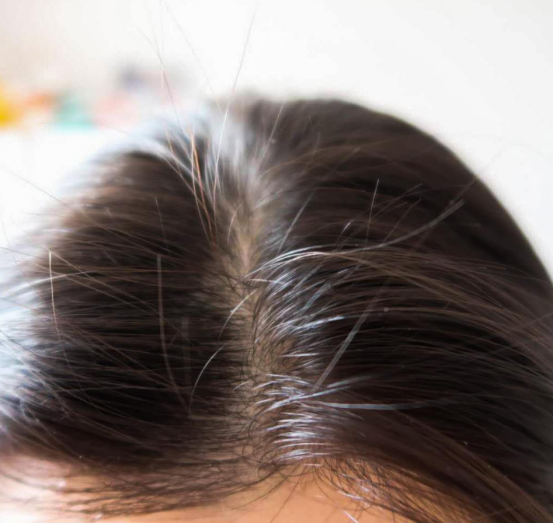 头皮屑多怎么治疗,头皮干燥头屑多怎么办?