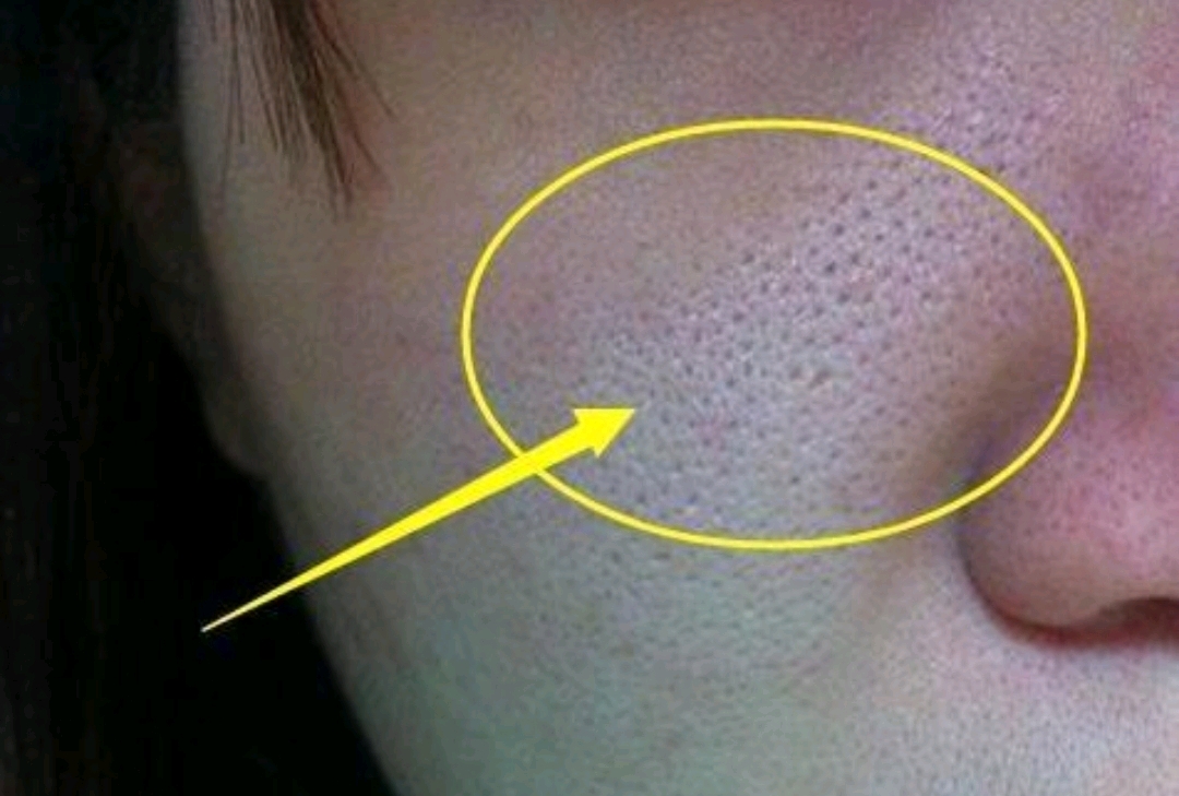 痘痘大多是由两个原因引起的,一个是因为皮肤属于油性皮肤,皮脂腺过于