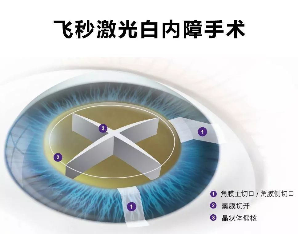 白内障治疗：拨开迷雾的光明之路