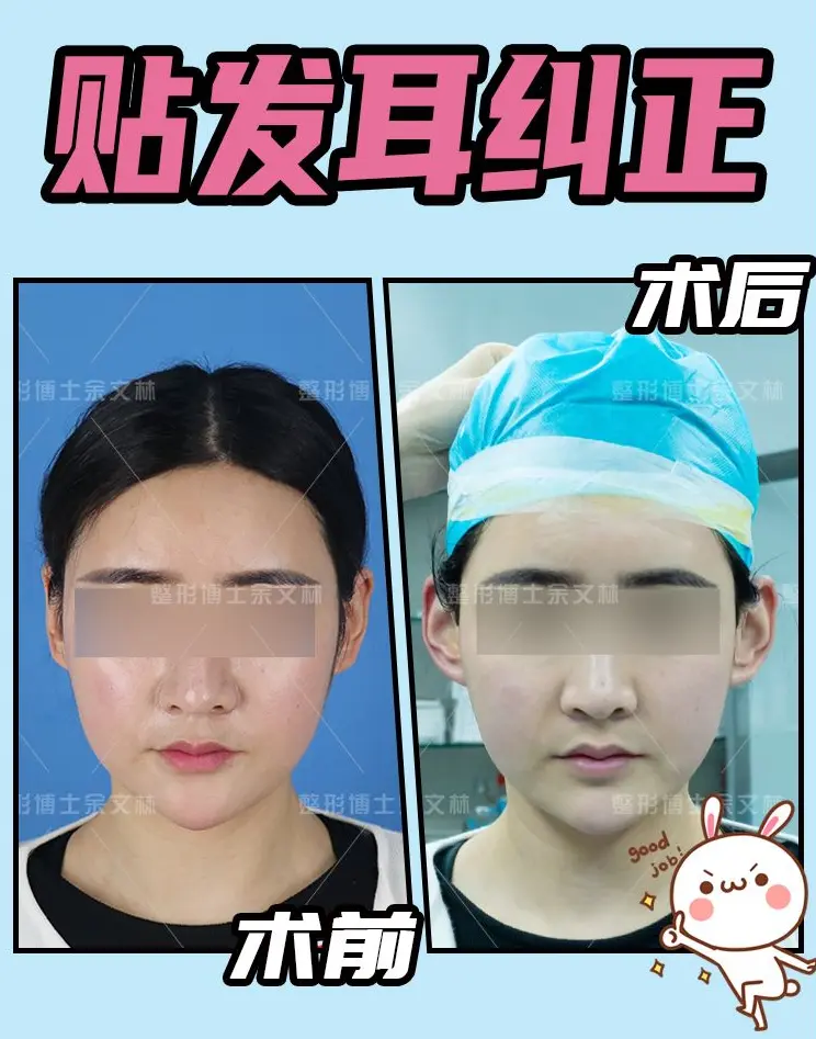 正面看不到耳朵好丑 贴发耳矫正术变美只需要40分钟 哔哩哔哩