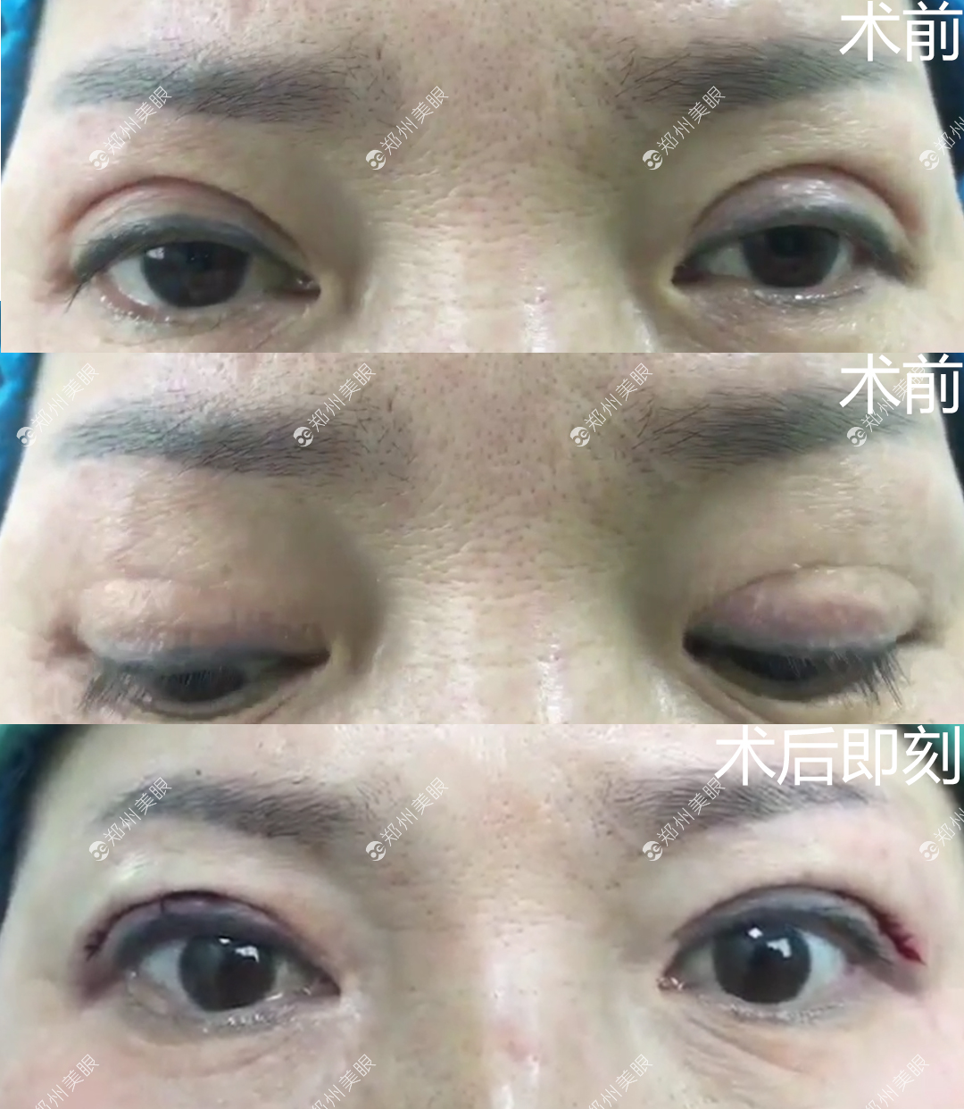 【韩勋案例】双眼皮修复术后6天 - 知乎