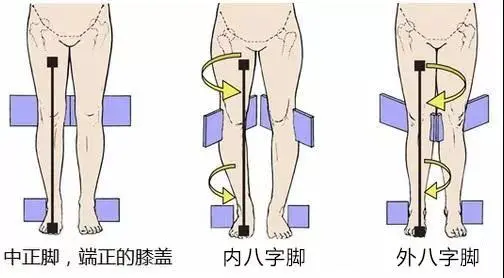 Xo型腿的危害及改善 看完这篇就懂了 哔哩哔哩