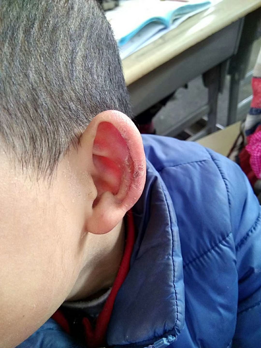 因为山里娃没有车接车送,又喜欢在室外跑,所以冬天经常耳朵冻烂,视频