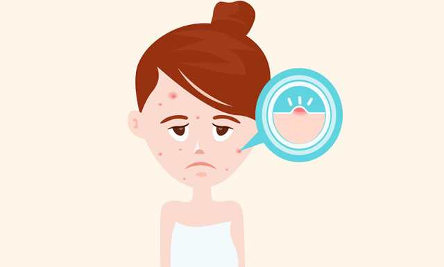 清楚自己长痘痘的原因,对症下药才是关键