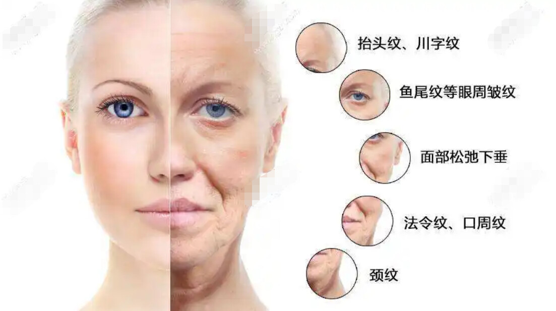 面部松弛凹陷,不知道先做面部提升还是填充? - 哔哩哔哩
