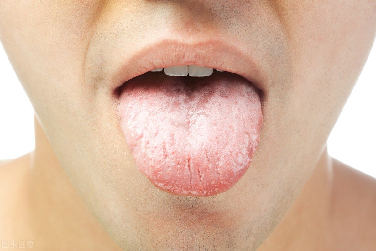 舌头上有裂纹是什么原因引起的？ - 知乎