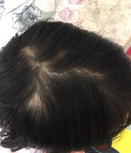 女性头发突然秃了一块 悲欢离合发落地