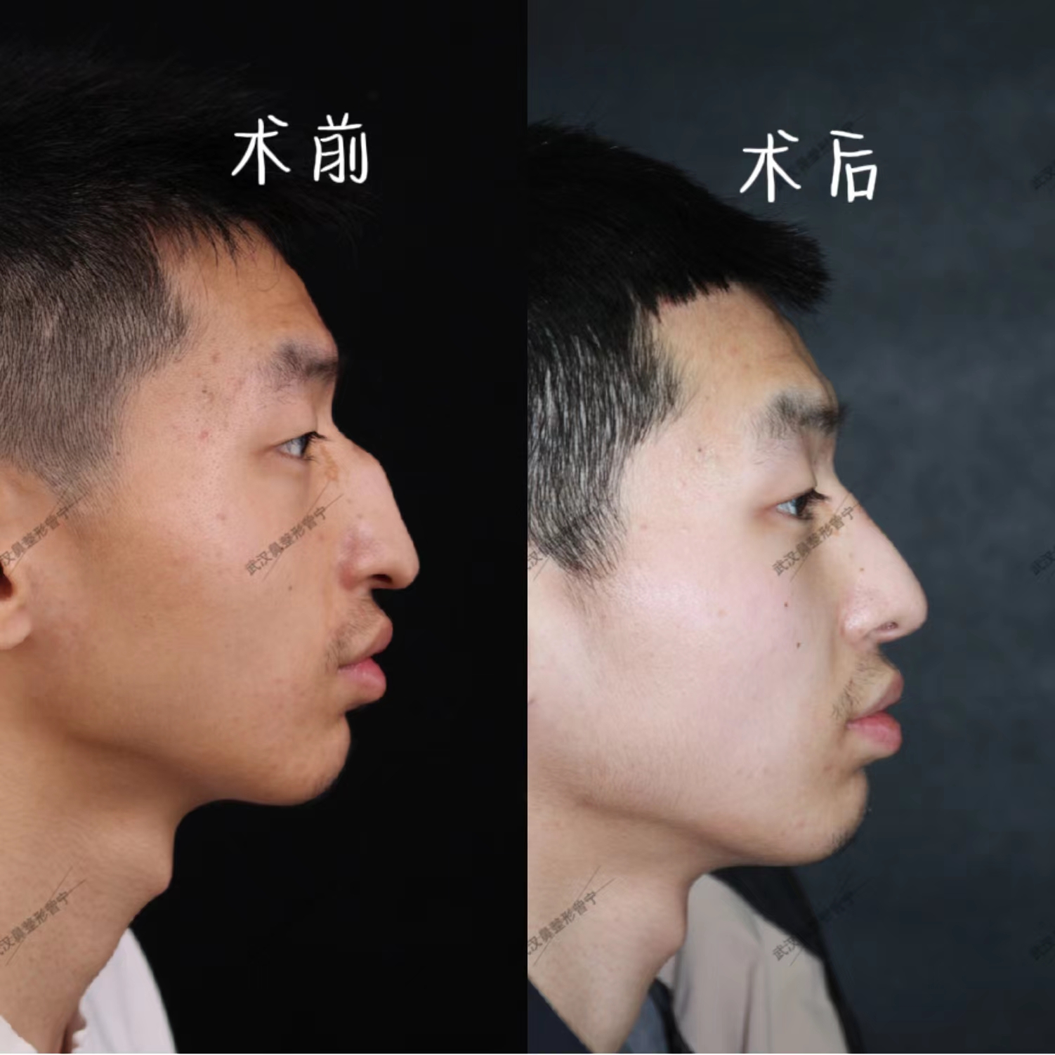 如何拥有刘亦菲同款理想鼻型——微驼峰仿生鼻功课！ - 知乎