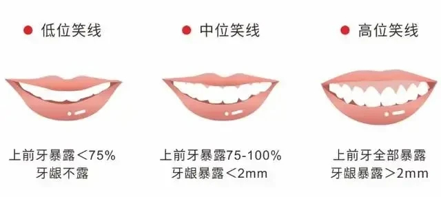 微笑美学丨什么人笑起来好看？聊聊笑得好看的7大标准 - 哔哩哔哩