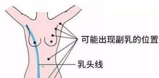 招飞体检常见异常:多乳症