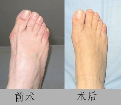 第第1跖骨头向外突出部分,可近似半球形.