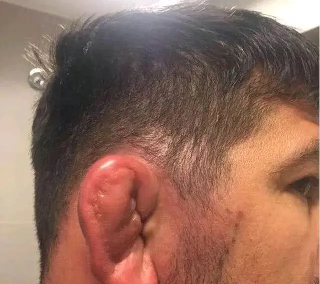 拳击手的耳朵居然都是畸形的 哔哩哔哩